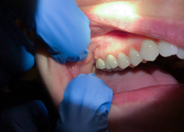 Emergency Dental Filling Replacement in MN